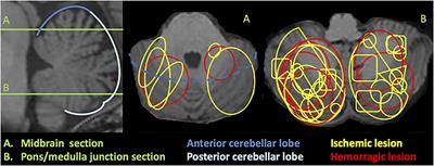 Cerebellar cognitive affective syndrome after acute cerebellar stroke